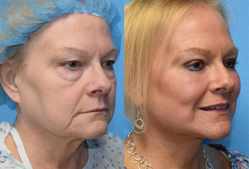 maningas-cosmetic-surgery-joplin-mo-gallery-test-image