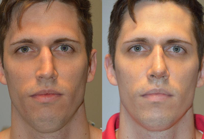 Nose reshaping results at Maningas Cosmetic Surgery in Joplin, MO and Northwest Arkansas