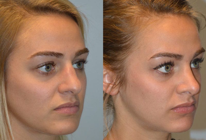 Nose reshaping results at Maningas Cosmetic Surgery in Joplin, MO and Northwest Arkansas