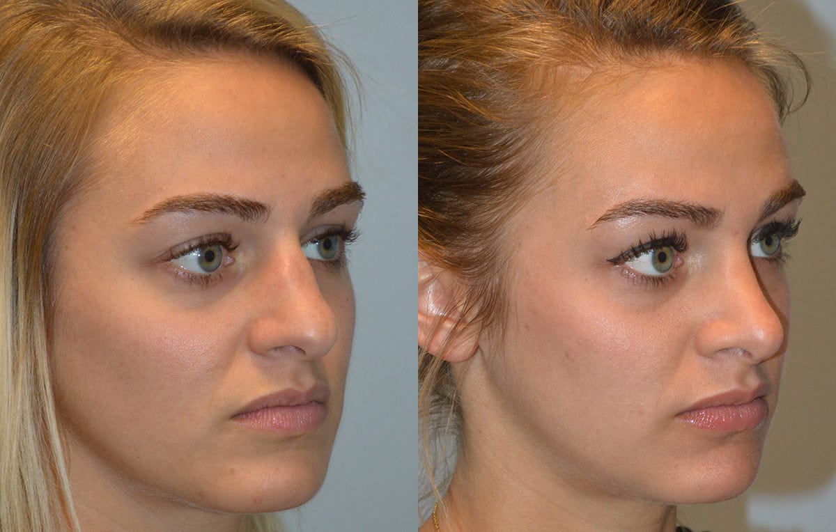 Nose reshaping results at Maningas Cosmetic Surgery in Joplin, MO and Northwest Arkansas