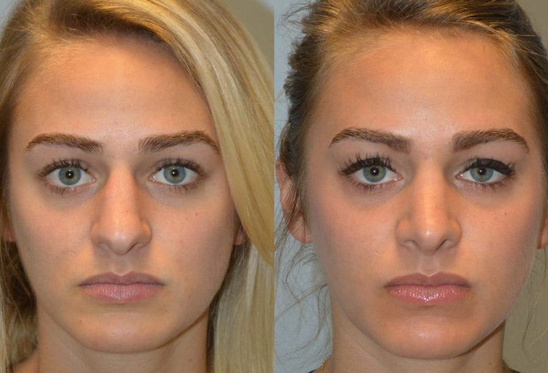 Nose reshaping results at Maningas Cosmetic Surgery in Joplin, MO and Northwest Arkansas