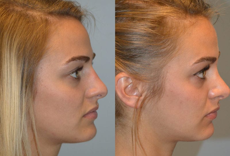 Nose reshaping results at Maningas Cosmetic Surgery in Joplin, MO and Northwest Arkansas