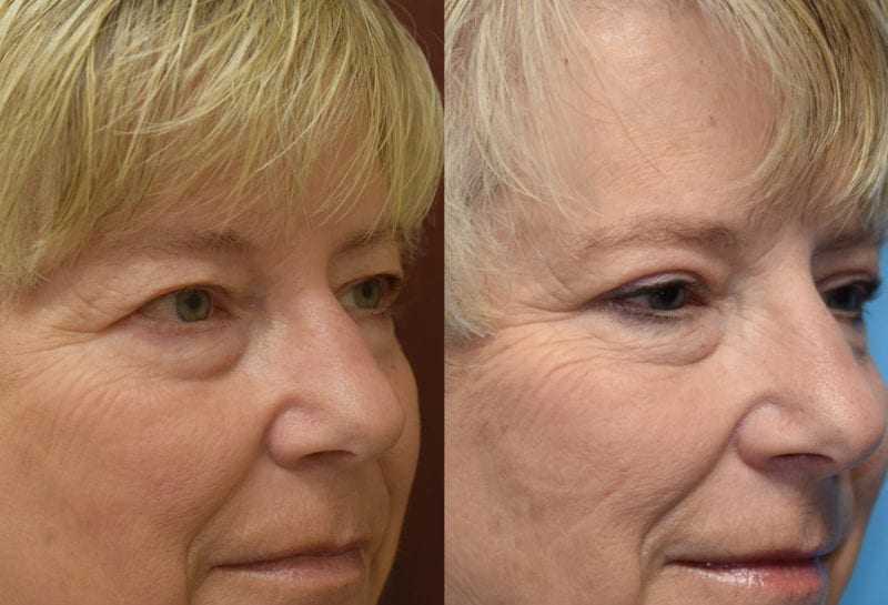 Eyelid surgery results at Maningas Cosmetic Surgery in Joplin, MO and Northwest Arkansas