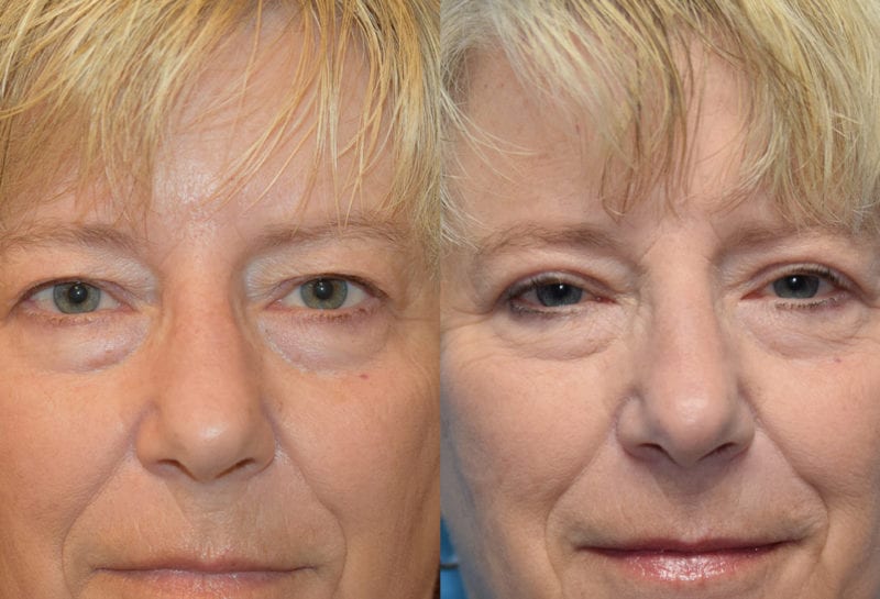 Eyelid surgery results at Maningas Cosmetic Surgery in Joplin, MO and Northwest Arkansas