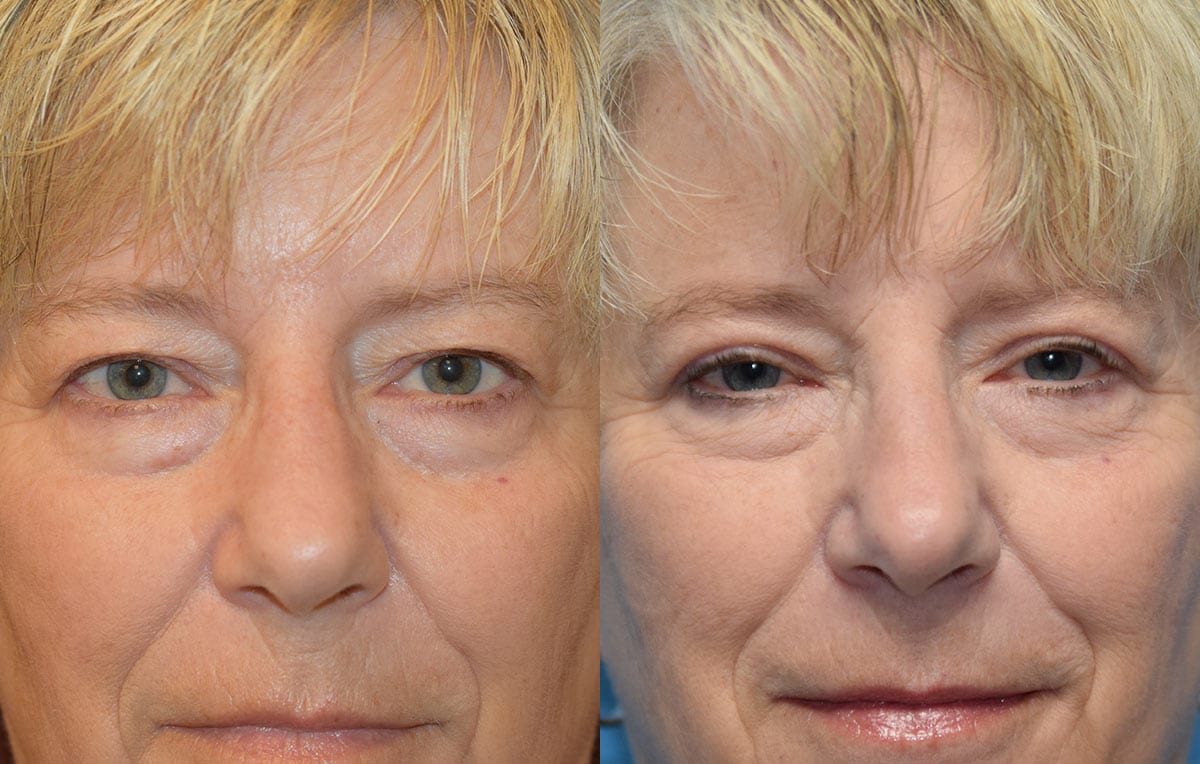 Eyelid surgery results at Maningas Cosmetic Surgery in Joplin, MO and Northwest Arkansas