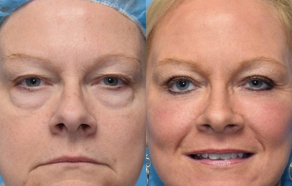 Eyelid Surgery results at Maningas Cosmetic Surgery in Joplin, MO and Northwest Arkansas