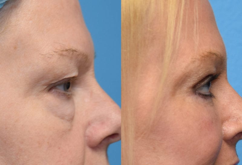 Eyelid surgery results at Maningas Cosmetic Surgery in Joplin, MO and Northwest Arkansas