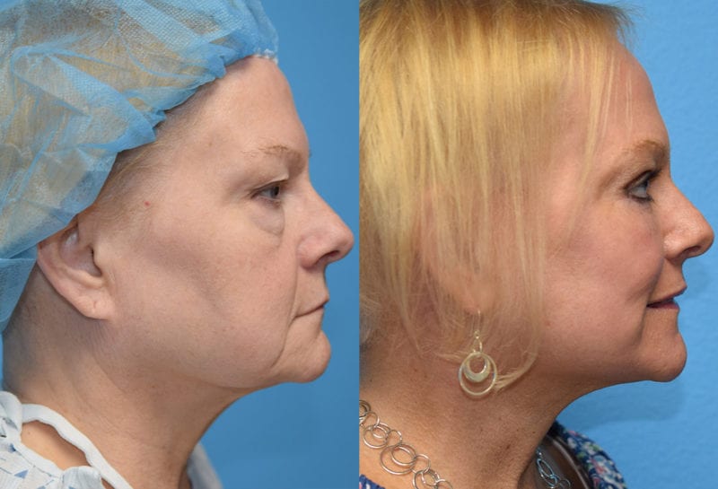 Facelift results at Maningas Cosmetic Surgery in Joplin, MO and Northwest Arkansas