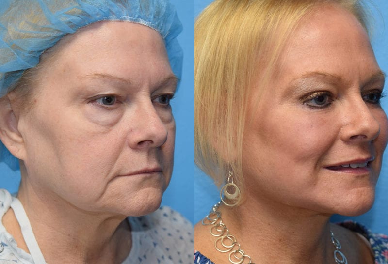 Facelift results at Maningas Cosmetic Surgery in Joplin, MO and Northwest Arkansas