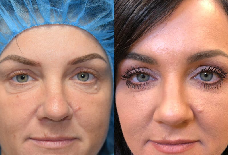 Eyelid surgery results at Maningas Cosmetic Surgery in Joplin, MO and Northwest Arkansas