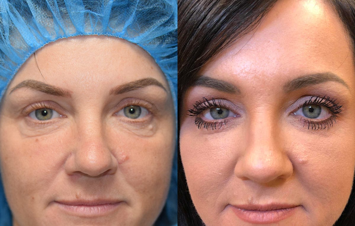 Eyelid surgery results at Maningas Cosmetic Surgery in Joplin, MO and Northwest Arkansas