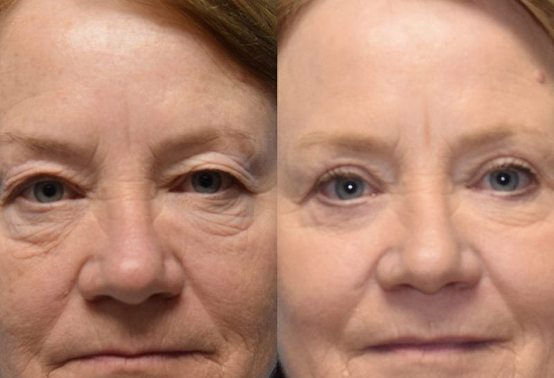 Eyelid surgery results at Maningas Cosmetic Surgery in Joplin, MO and Northwest Arkansas