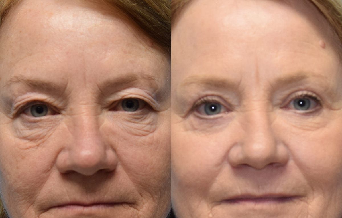 Eyelid surgery results at Maningas Cosmetic Surgery in Joplin, MO and Northwest Arkansas