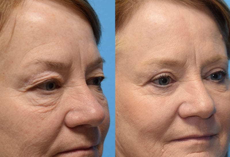 Eyelid surgery results at Maningas Cosmetic Surgery in Joplin, MO and Northwest Arkansas