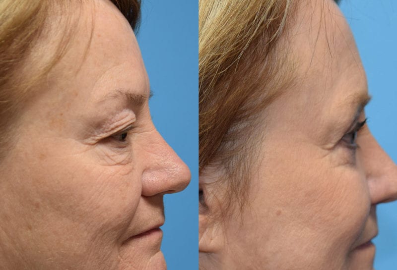 Eyelid surgery results at Maningas Cosmetic Surgery in Joplin, MO and Northwest Arkansas