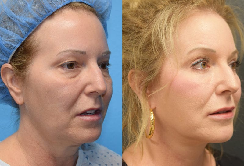 Facelift results at Maningas Cosmetic Surgery in Joplin, MO and Northwest Arkansas