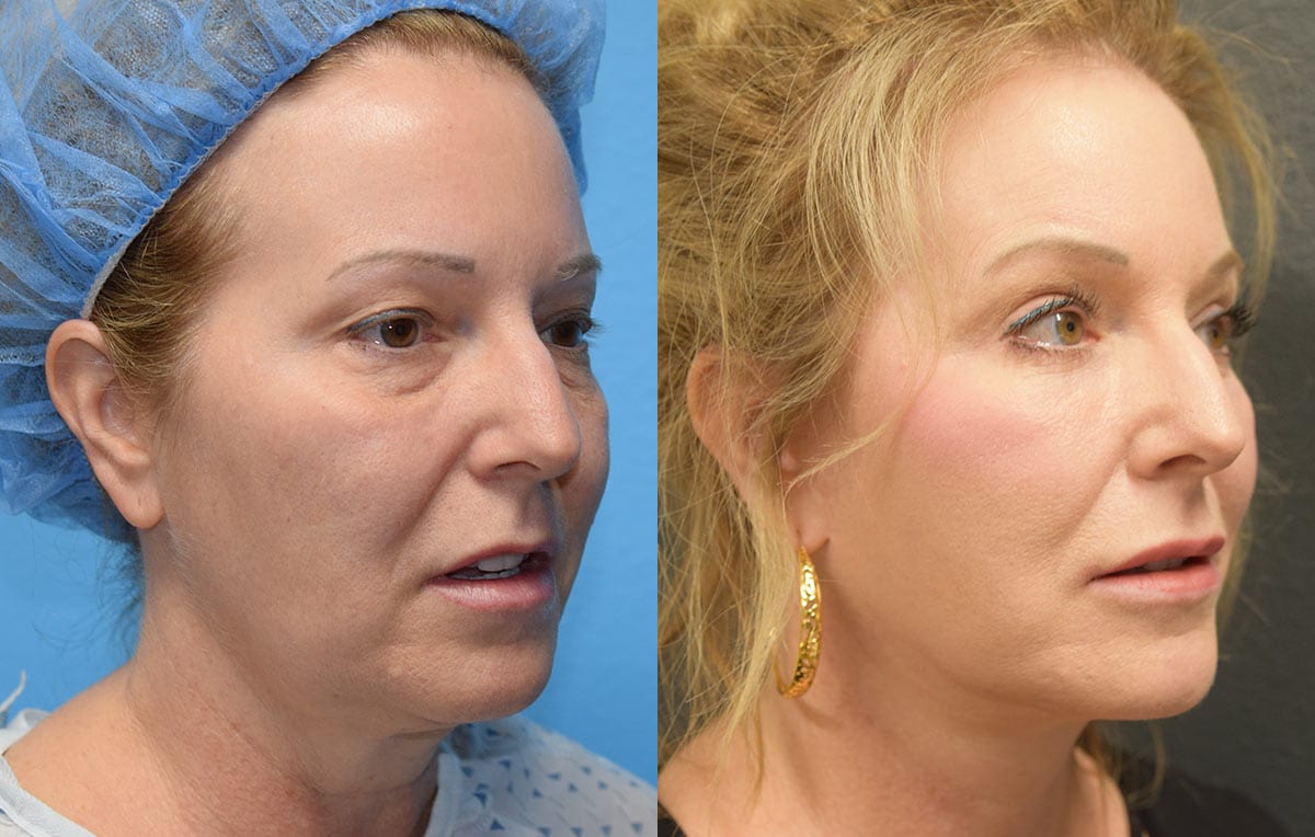 Facelift results at Maningas Cosmetic Surgery in Joplin, MO and Northwest Arkansas