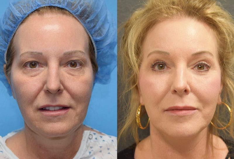 Facelift results at Maningas Cosmetic Surgery in Joplin, MO and Northwest Arkansas