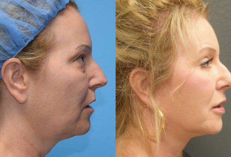 Facelift results at Maningas Cosmetic Surgery in Joplin, MO and Northwest Arkansas