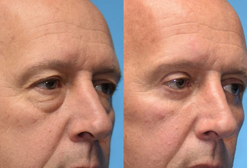 Eyelid surgery results at Maningas Cosmetic Surgery in Joplin, MO and Northwest Arkansas