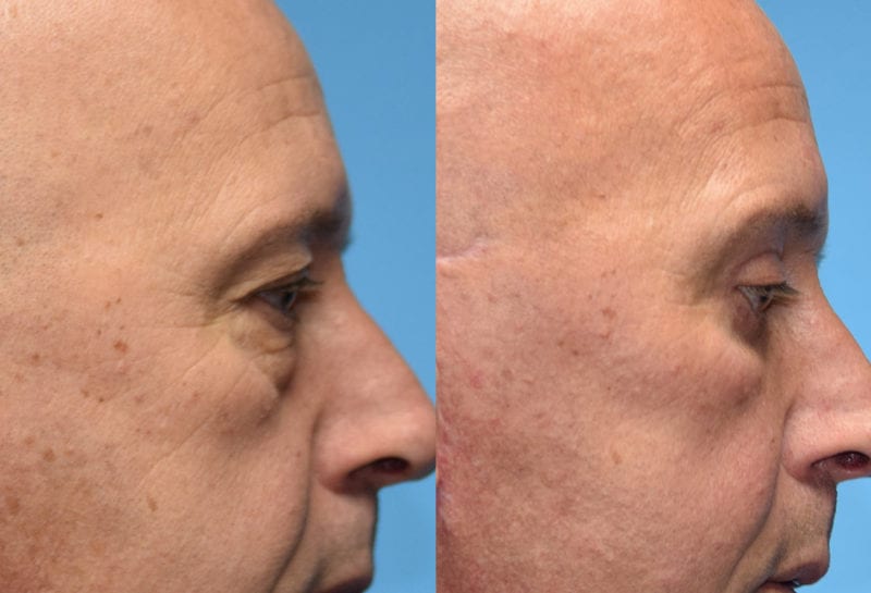 Eyelid surgery results at Maningas Cosmetic Surgery in Joplin, MO and Northwest Arkansas