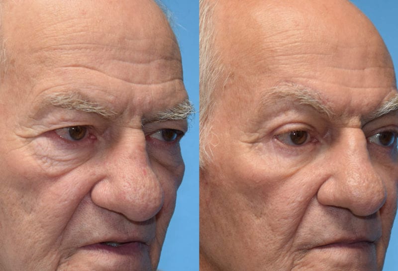 Eyelid surgery results at Maningas Cosmetic Surgery in Joplin, MO and Northwest Arkansas