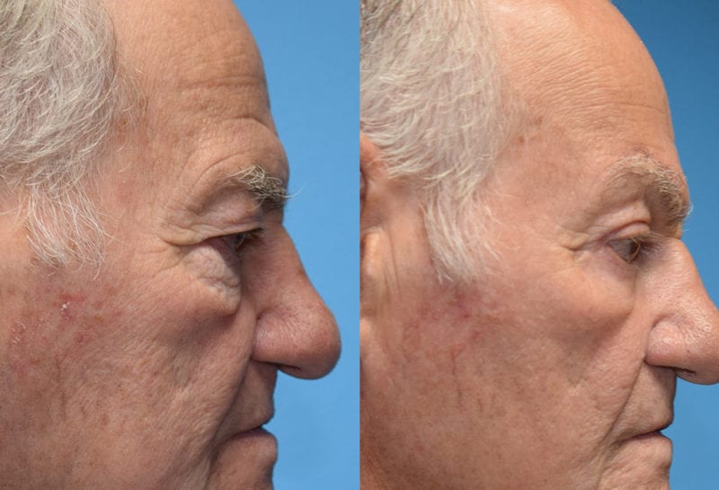 Eyelid surgery results at Maningas Cosmetic Surgery in Joplin, MO and Northwest Arkansas