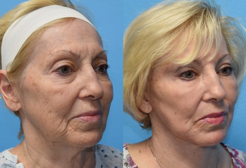 Facelift results at Maningas Cosmetic Surgery in Joplin, MO and Northwest Arkansas