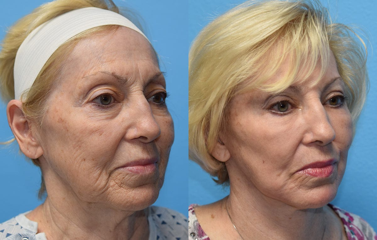 Facelift results at Maningas Cosmetic Surgery in Joplin, MO and Northwest Arkansas