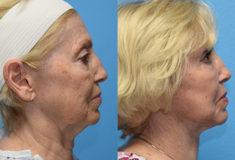 Facelift results at Maningas Cosmetic Surgery in Joplin, MO and Northwest Arkansas