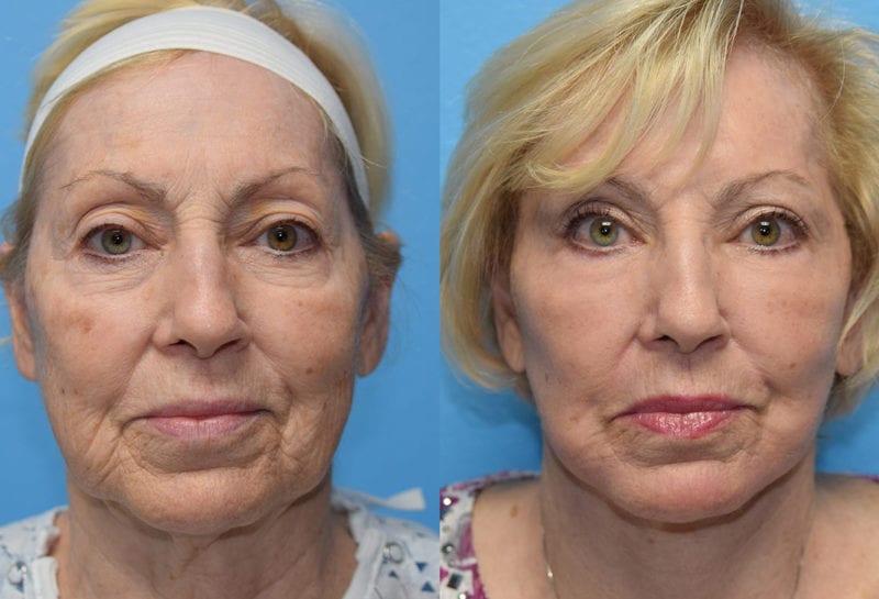 Facelift results at Maningas Cosmetic Surgery in Joplin, MO and Northwest Arkansas