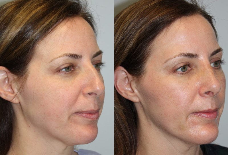 Nose reshaping results at Maningas Cosmetic Surgery in Joplin, MO and Northwest Arkansas