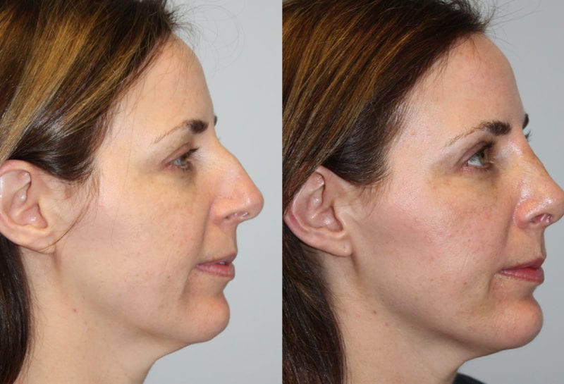 Nose reshaping results at Maningas Cosmetic Surgery in Joplin, MO and Northwest Arkansas