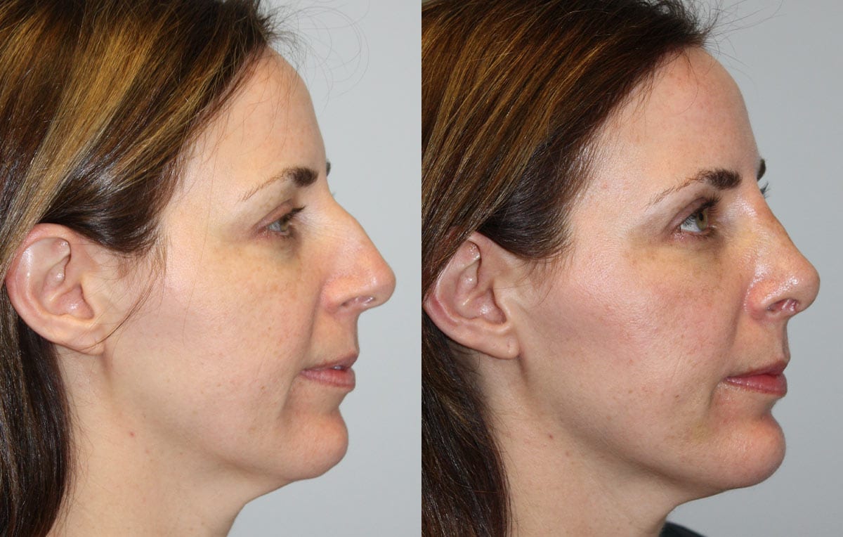 Nose reshaping results at Maningas Cosmetic Surgery in Joplin, MO and Northwest Arkansas