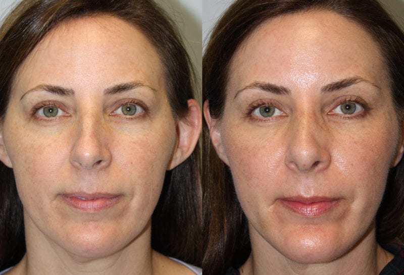 Nose reshaping results at Maningas Cosmetic Surgery in Joplin, MO and Northwest Arkansas