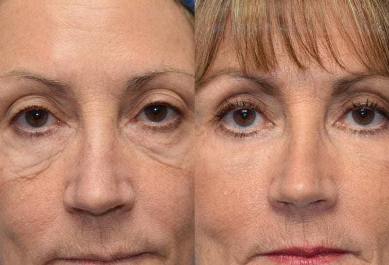 Eyelid surgery results at Maningas Cosmetic Surgery in Joplin, MO and Northwest Arkansas