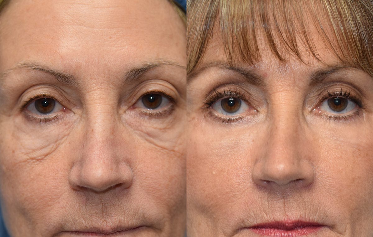 Eyelid surgery results at Maningas Cosmetic Surgery in Joplin, MO and Northwest Arkansas