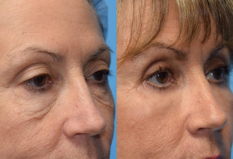 Eyelid surgery results at Maningas Cosmetic Surgery in Joplin, MO and Northwest Arkansas