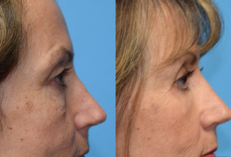 Eyelid surgery results at Maningas Cosmetic Surgery in Joplin, MO and Northwest Arkansas