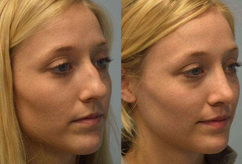 Nose reshaping results at Maningas Cosmetic Surgery in Joplin, MO and Northwest Arkansas