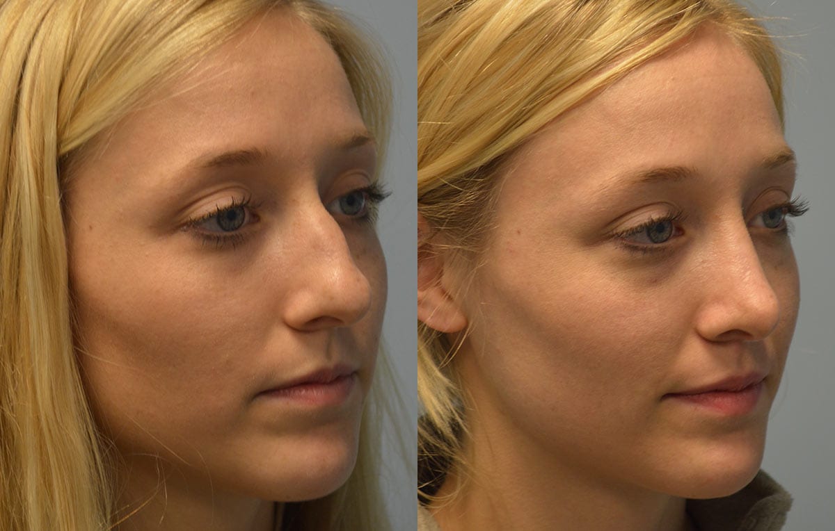 Nose reshaping results at Maningas Cosmetic Surgery in Joplin, MO and Northwest Arkansas