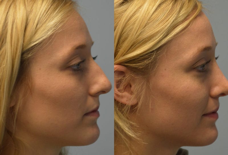 Nose reshaping results at Maningas Cosmetic Surgery in Joplin, MO and Northwest Arkansas