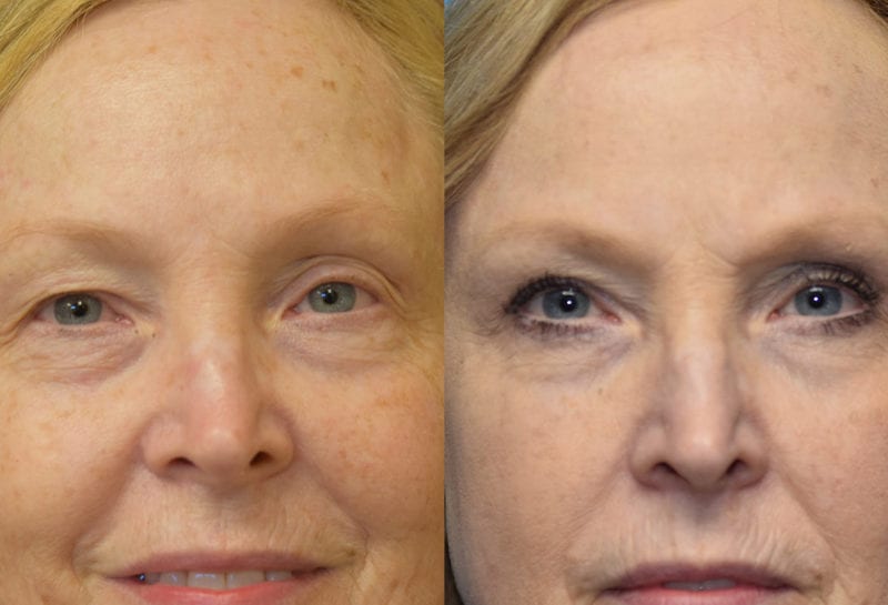 Eyelid surgery results at Maningas Cosmetic Surgery in Joplin, MO and Northwest Arkansas