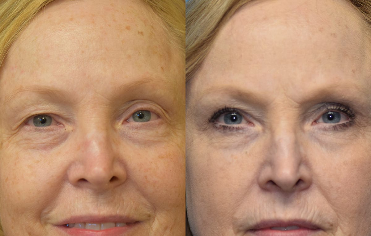 Eyelid surgery results at Maningas Cosmetic Surgery in Joplin, MO and Northwest Arkansas