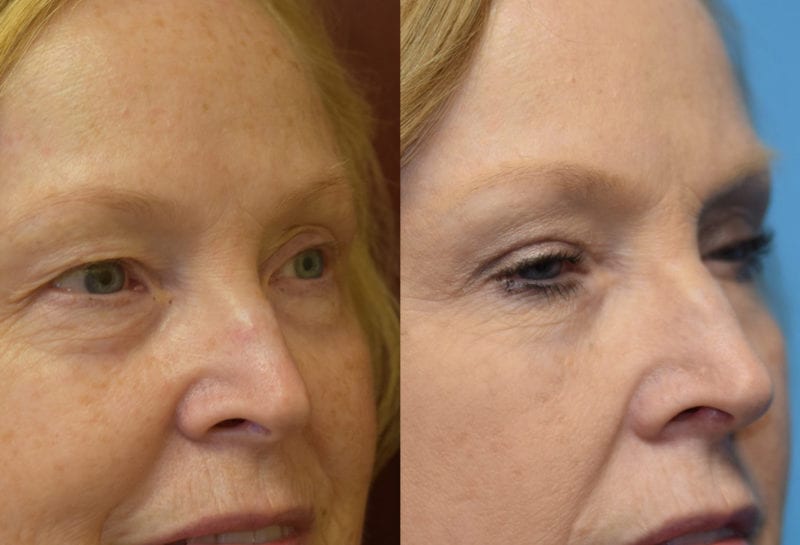 Eyelid surgery results at Maningas Cosmetic Surgery in Joplin, MO and Northwest Arkansas