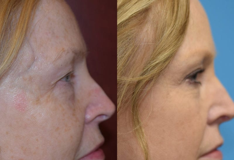 Eyelid surgery results at Maningas Cosmetic Surgery in Joplin, MO and Northwest Arkansas