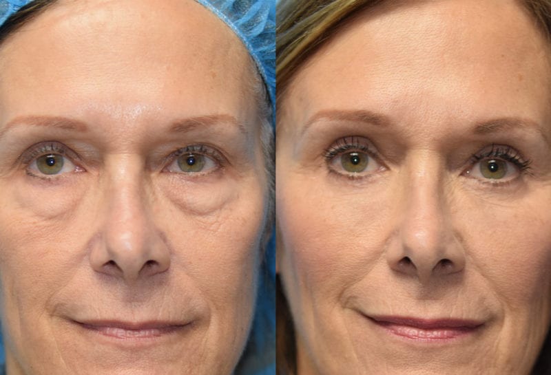 Eyelid surgery results at Maningas Cosmetic Surgery in Joplin, MO and Northwest Arkansas