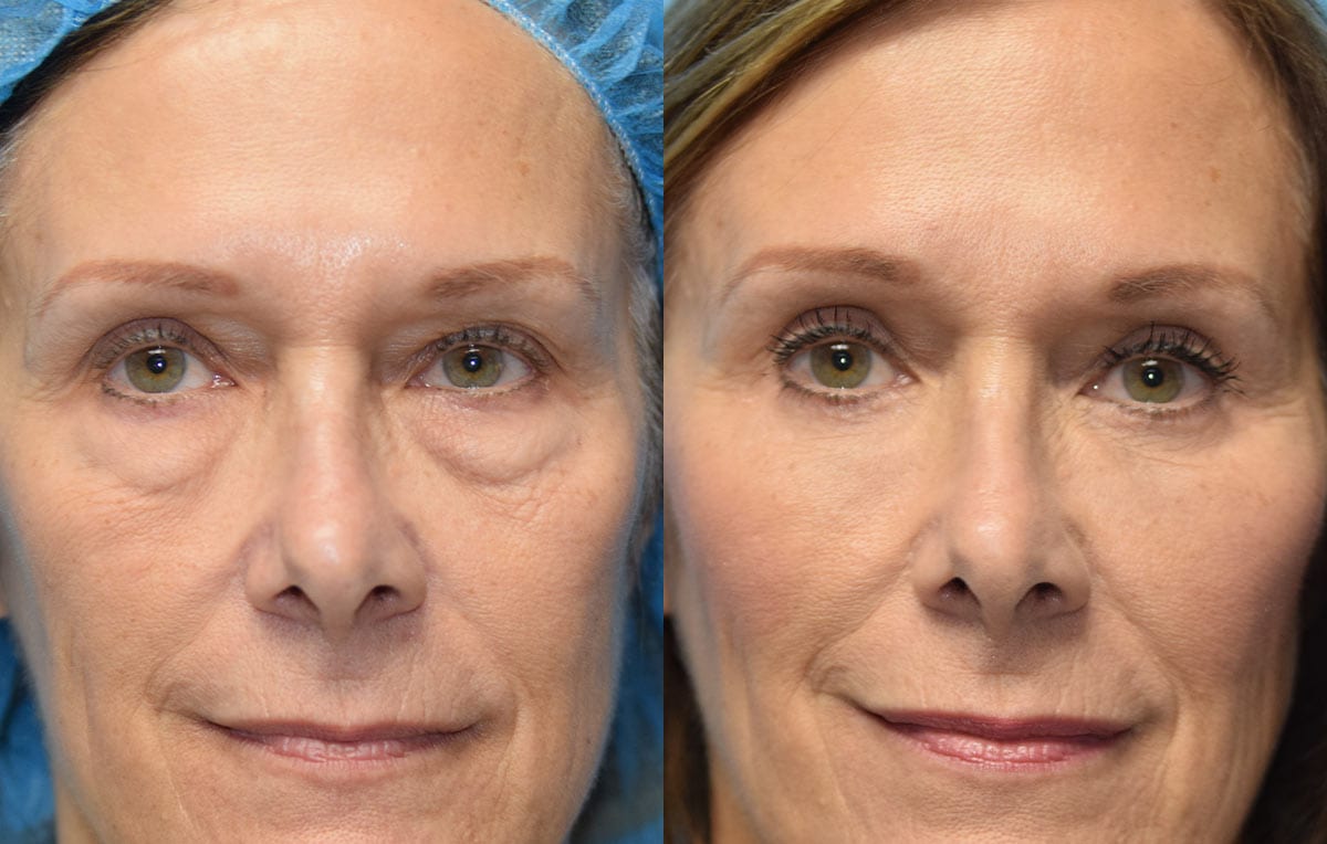 Eyelid surgery results at Maningas Cosmetic Surgery in Joplin, MO and Northwest Arkansas