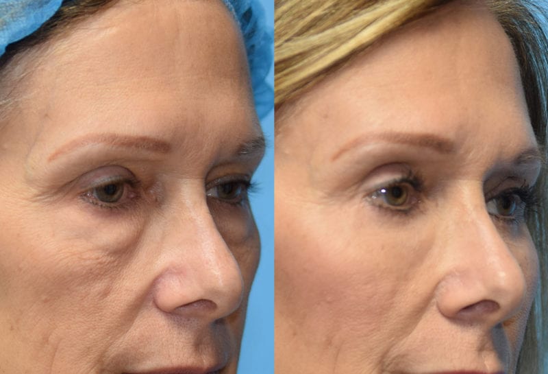 Eyelid surgery results at Maningas Cosmetic Surgery in Joplin, MO and Northwest Arkansas