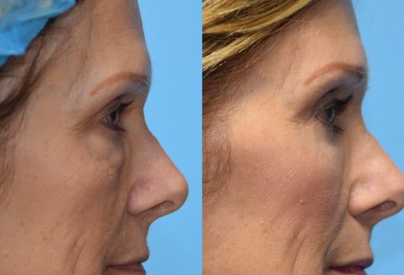 Eyelid surgery results at Maningas Cosmetic Surgery in Joplin, MO and Northwest Arkansas